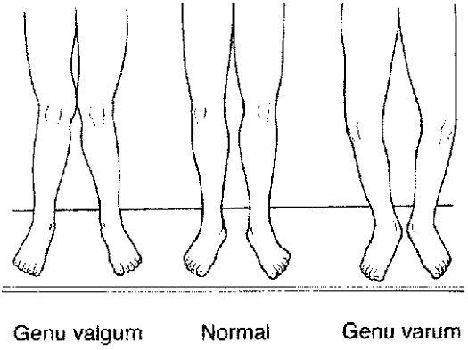Diferentes formatos do ângulo do joelho